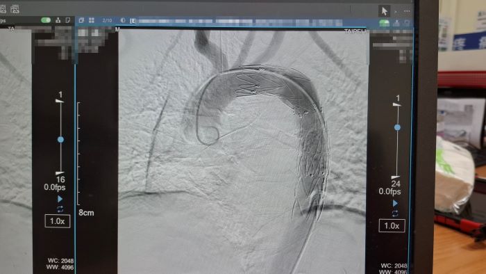 《圖說》展開主動脈腔內血管支架置放手術，封堵出血點。〈臺北醫院提供〉