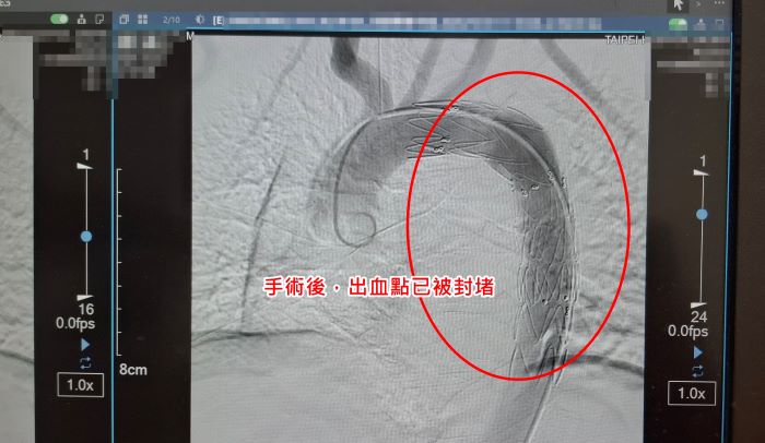 《圖說》手術後，出血點已被封堵。〈臺北醫院提供〉